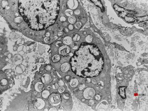 F, 2m. | surfactant deficiency